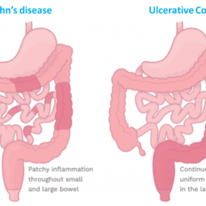 crohns vs ulcerative colitis
