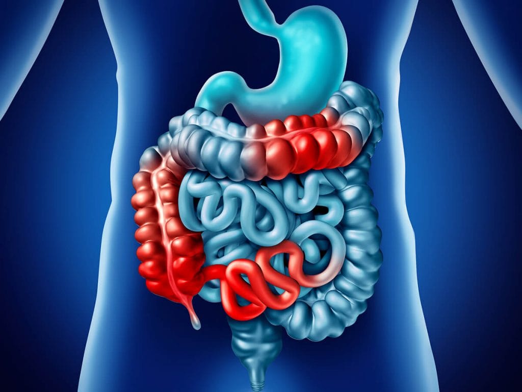 ibd inflammatory bowel disease