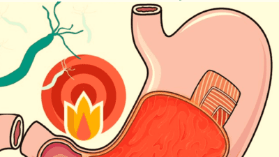 gastritis list