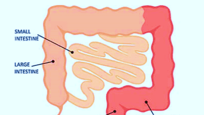colitis list