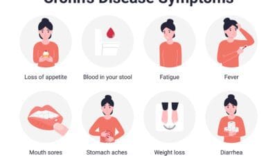 crohns symptoms candor