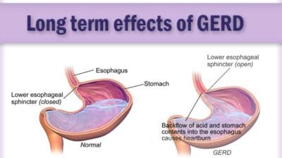Long term effects of GERD candor
