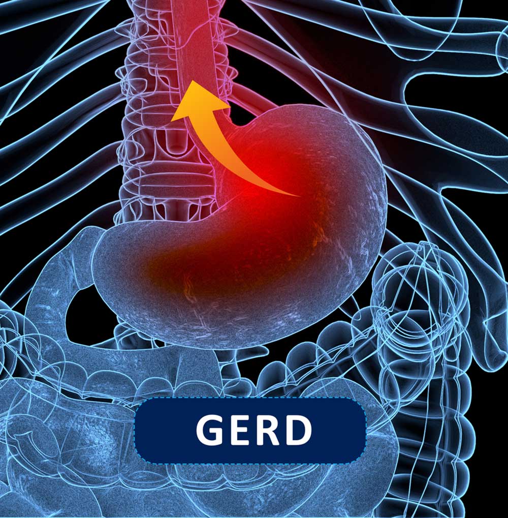 What can I eat during a flare-up with reflux or GERD?