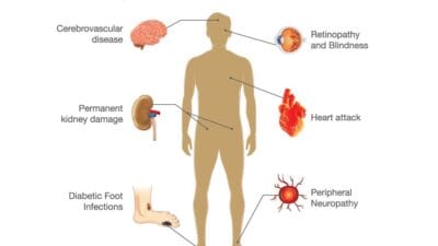 Picture of long term effects diabetes for Candor ranked list